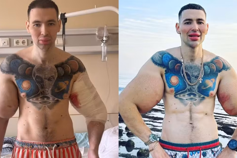 'Popeye russo' pode perder os dois braços após infecção causada por injeções de óleo