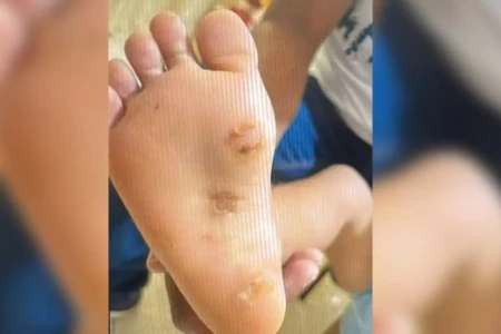 criança x queimaduras