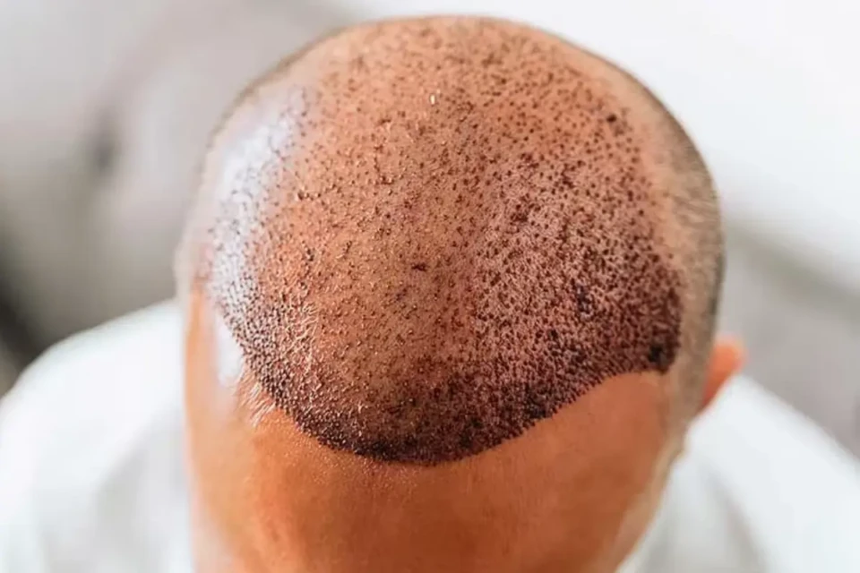 Veja se existe idade certa para transplante capilar (Foto: Reprodução)