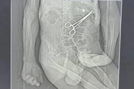 Família acusa hospital de esquecer pinça em corpo de idoso morto (Foto: Reprodução)