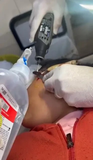 Bombeiros usam microrretífica para remover a peça de metal (Foto: Bombeiros)