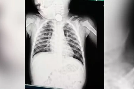 Exame revelou bateria do brinquedo lousa mágica no esôfago do bebê (Foto: redes sociais)