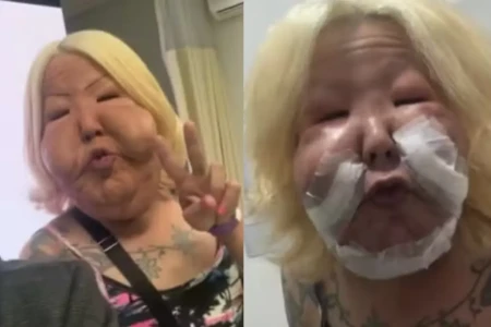 Imagens fortes: médico mostra 2ª cirurgia para retirada de óleo mineral do rosto de Juju do Pix Cirurgião mostrou parte da última intervenção