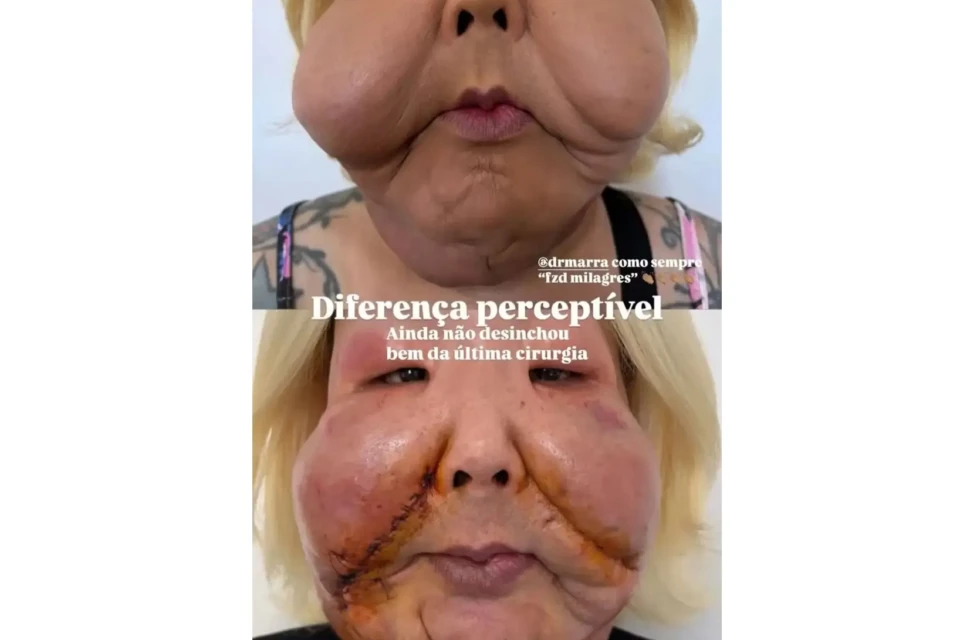 Imagens fortes: médico mostra 2ª cirurgia para retirada de óleo mineral do rosto de Juju do Pix Cirurgião mostrou parte da última intervenção