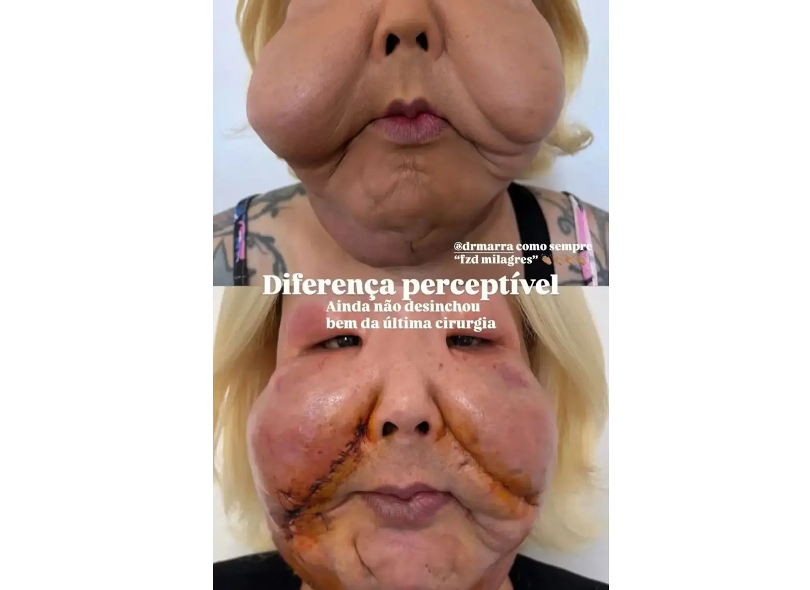 Imagens fortes: médico mostra 2ª cirurgia para retirada de óleo mineral do rosto de Juju do Pix Cirurgião mostrou parte da última intervenção