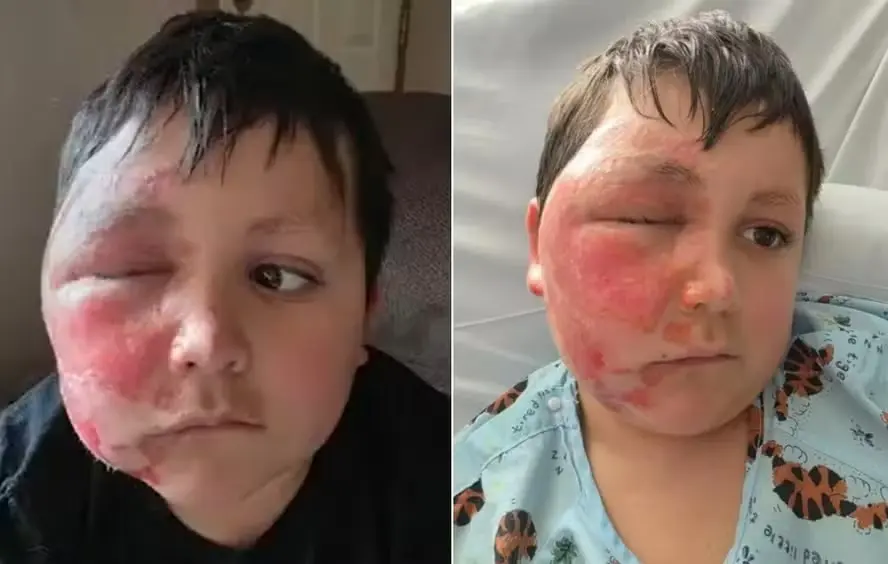 image Menino fica com o rosto deformado após participar de desafio no TikTok; veja foto