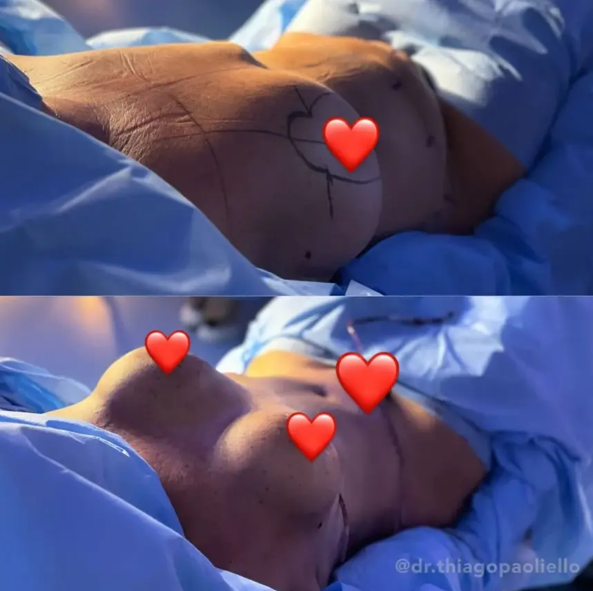 Mãe de Virginia Fonseca passa por abdominoplastia e mamoplastia; veja antes e depois 3 image Mãe de Virginia Fonseca passa por abdominoplastia e mamoplastia; veja antes e depois