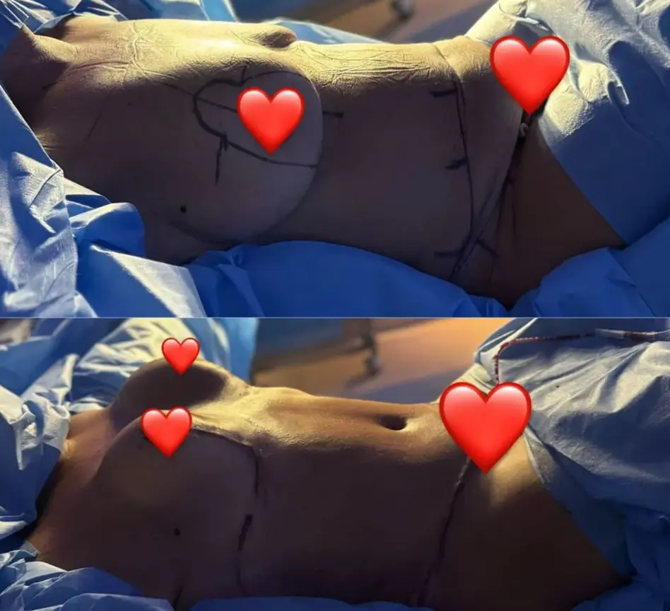 Mãe de Virginia Fonseca passa por abdominoplastia e mamoplastia; veja antes e depois 4 image Mãe de Virginia Fonseca passa por abdominoplastia e mamoplastia; veja antes e depois