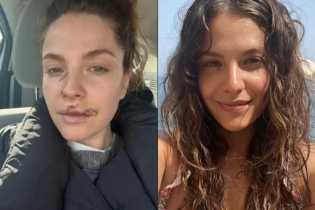 Atriz de 'The Good Doctor' revela ter sofrido ataque de cachorro e mostra rosto ferido (Foto: Instagram)