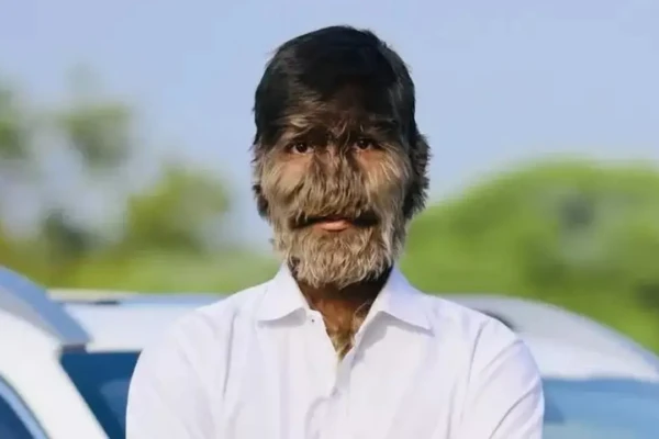 Lalit Patidar síndrome do lobisomem Jovem com o rosto mais peludo do mundo celebra 'emprego dos sonhos'; veja fotos