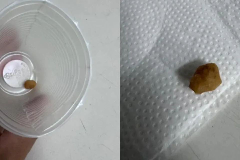 Possível pedra de crack retirada do estômago do garoto - (Foto: reprodução/PM)
