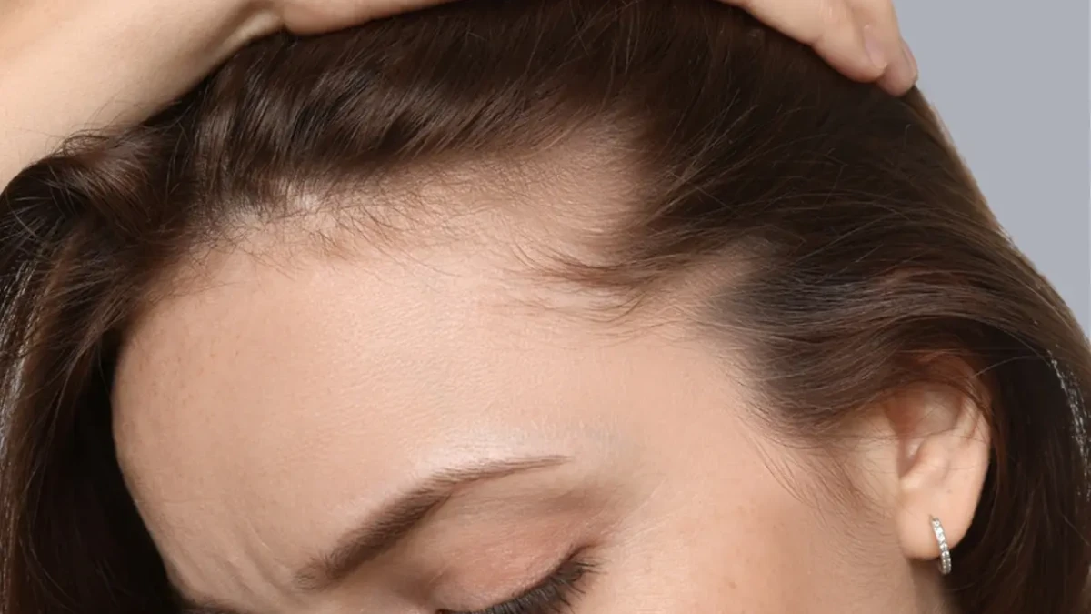 Homens e mulheres podem se inscrever estudo clínico queda de cabelo ICF Goiás busca voluntários para tratamento; veja como participar