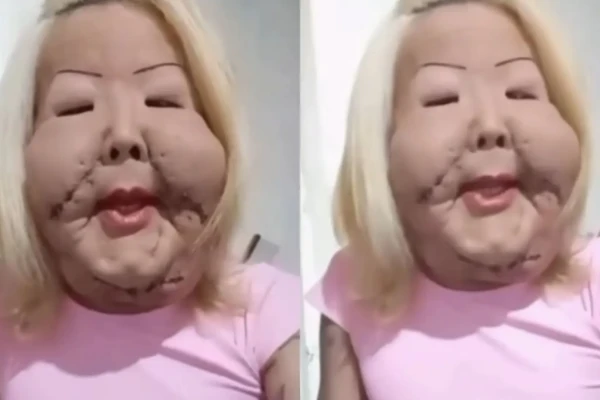 Juju do Pix recebe alta uma semana após implantar silicone nos seios; veja antes e depois Foram implantados 550 ml em cada mama