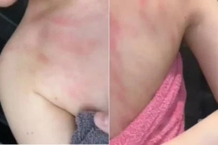 Mulher alérgica à água diz sentir dores intensas ao tomar banho; entenda Urticária aquagênica causa erupções cutâneas vermelha e elevadas