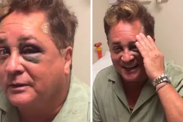 Leonardo de olho roxo após cair em pescaria