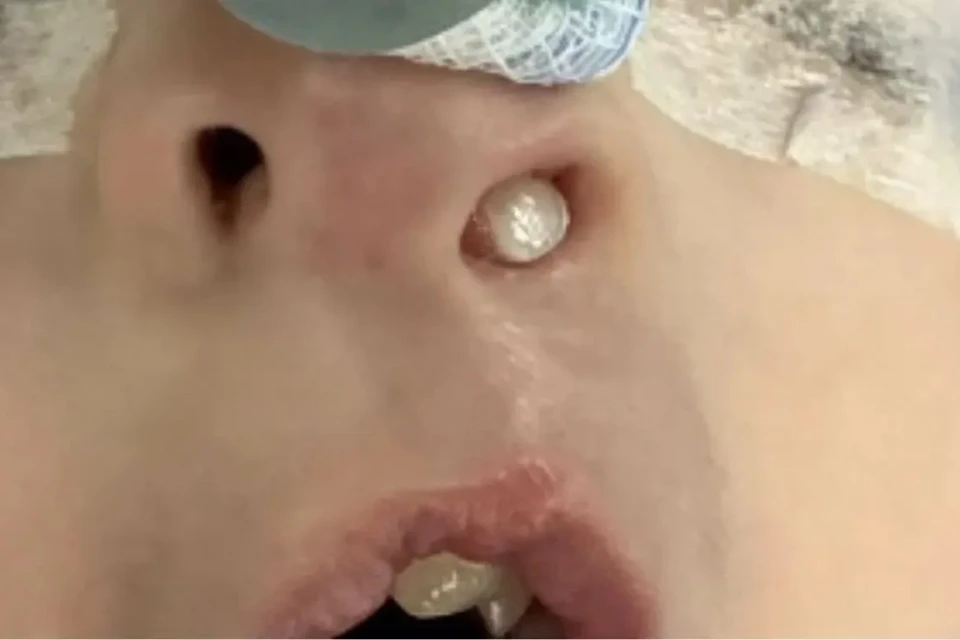 Criança de 3 anos passa por cirurgia após dente crescer dentro do nariz; veja fotos Dente ectópico é raro e pode passar despercebido
