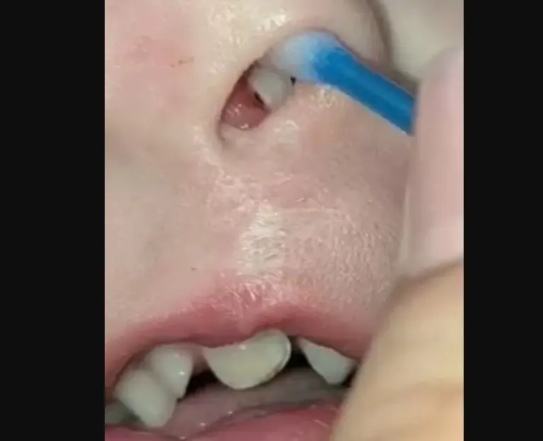 Criança de 3 anos passa por cirurgia após dente crescer dentro do nariz; veja fotos Dente ectópico é raro e pode passar despercebido