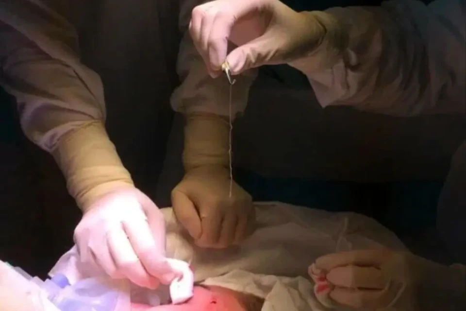 Jovem passa um ano com verme de 15 cm no rosto; veja foto Anna acredita que tenha contraído o parasita durante férias