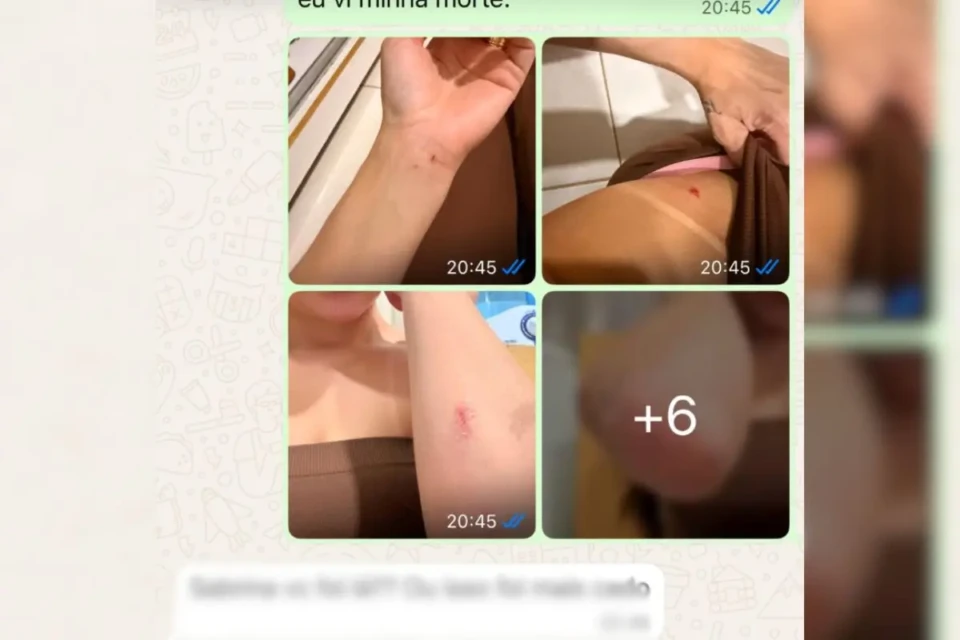 Sabrina Ferreira publicou fotografias nas quais aparecem lesões em diferentes partes do corpo e afirmou que deixou a casa após esse episódio (Foto: Reprodução)