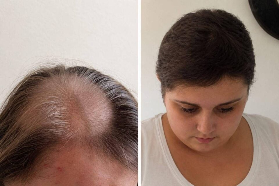 diagnóstico de câncer cerebral Mulher passa 11 anos em quimioterapia e descobre que nunca teve câncer Becky Jones