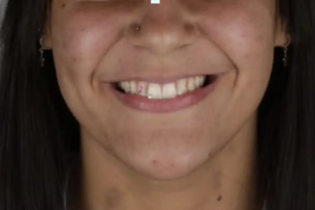 cristais nos dentes
