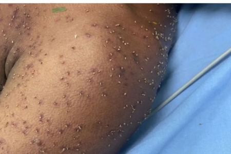 Marcas de múltiplas picadas de abelhas na pele do homem atacado por um enxame na zona rural de Itapuranga