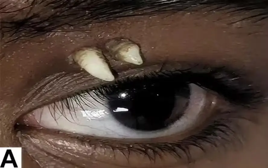 Imagens fortes: jovem vai ao hospital e descobre dente nascendo na região do olho
